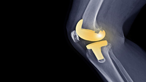 Knee Replacement